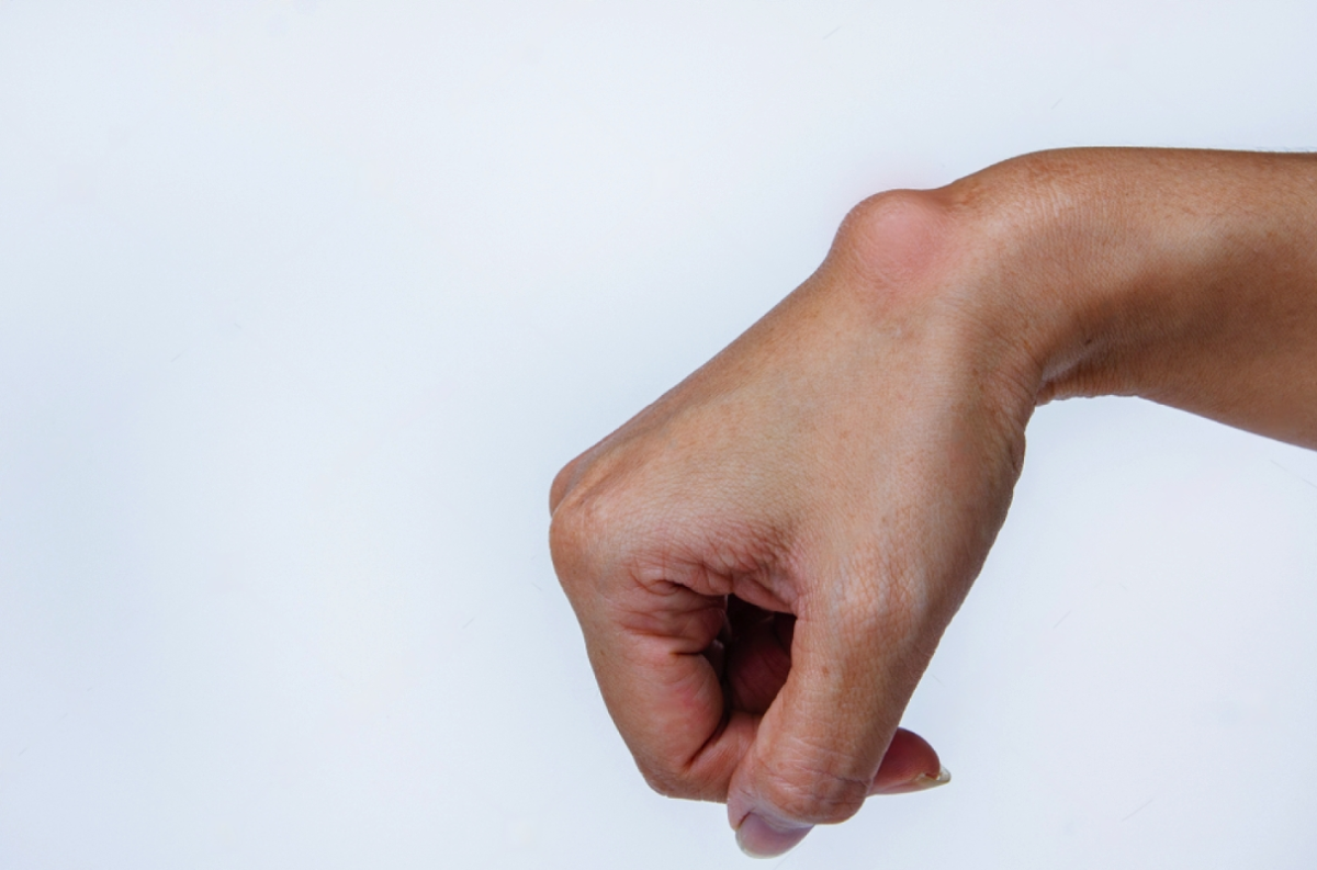 Ganglion Cyst Removal Surgery in Quezon City