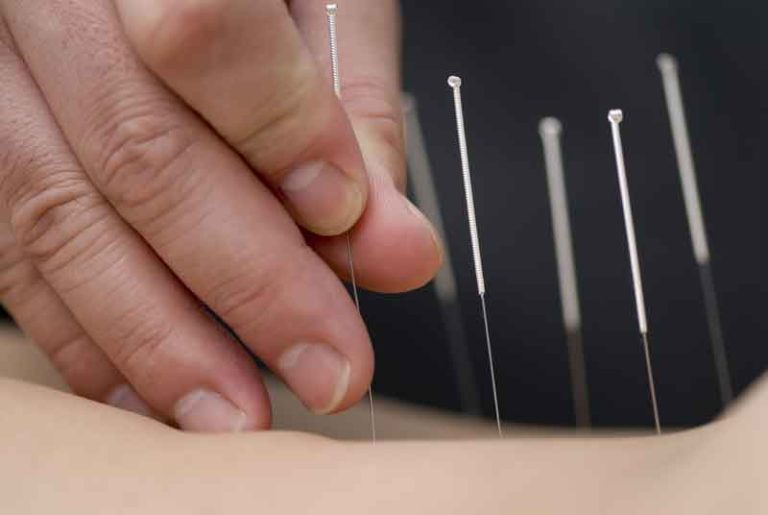 Dry Needling Treatment