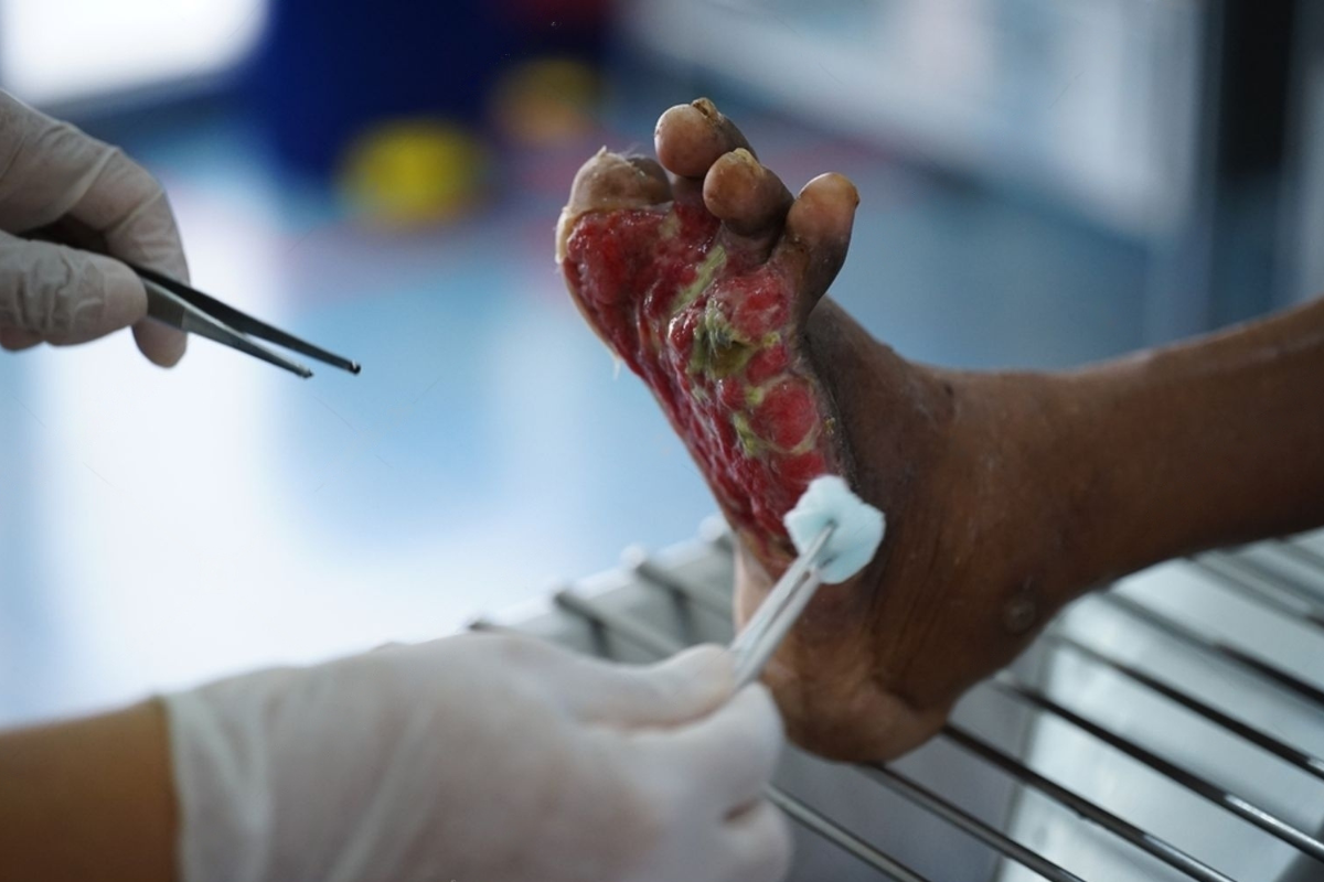 Orthopedic Treatment for Diabetic Foot Disease