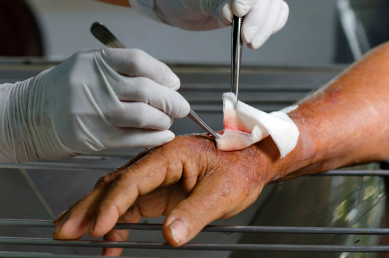 Orthopedic Treatment for Infected Wounds