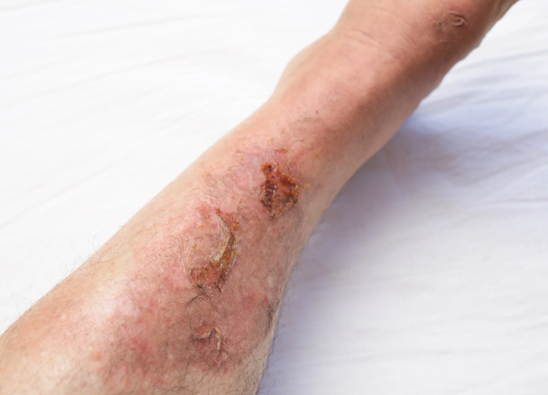 Orthopedic Treatment for Non-Healing Wounds