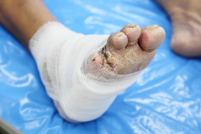 Orthopedic Treatment for Forefoot Ulcers