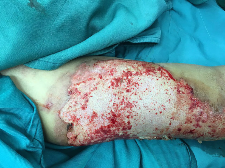 Photo of Burn wound debridement Philippines