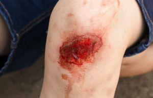 knee wound not healing