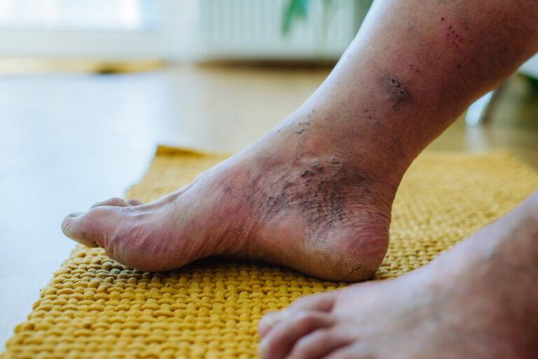Comprehensive Diabetic Foot Ulcer Management Effective Strategies for Prevention and Healing
