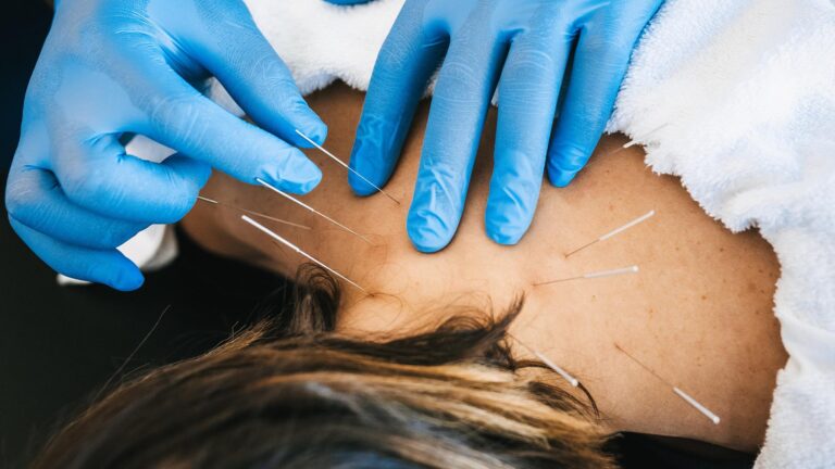 Dry Needling Treatment in Fishers, IN A Comprehensive Guide to Pain Relief and Recovery